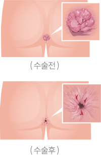 치핵이미지