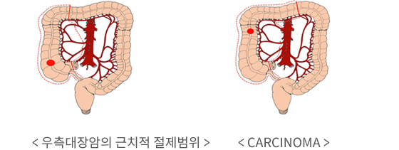 우측결장 절제술 이미지