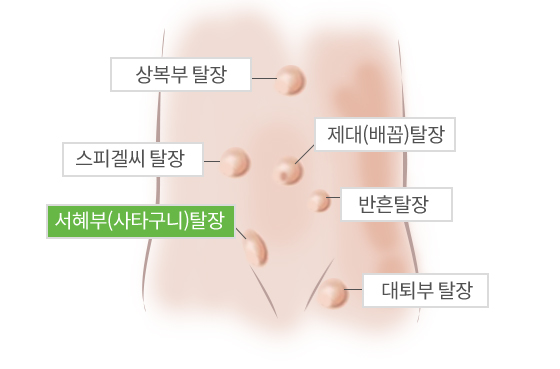 탈장이미지