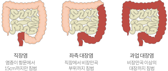 궤양성 대장염 이미지