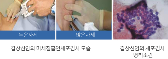 갑상선 기능검사 이미지