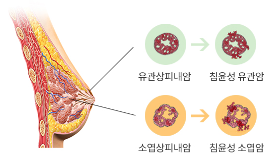 유방암 이미지